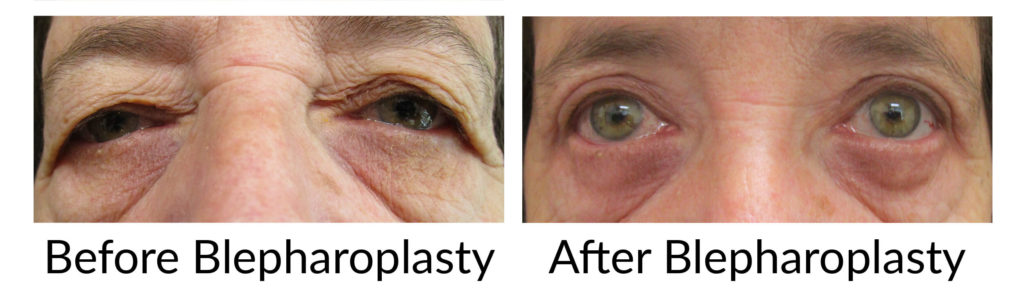 Blepharoplasty After