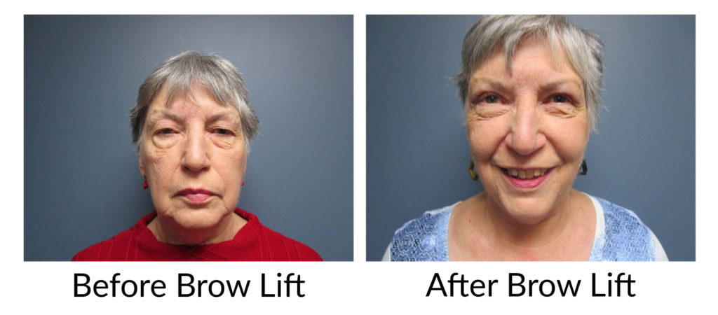 Before After Brow Lift