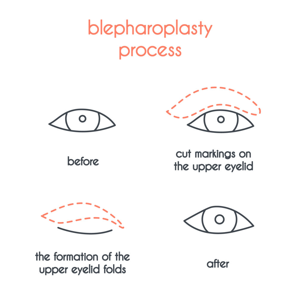 Blepharoplasty