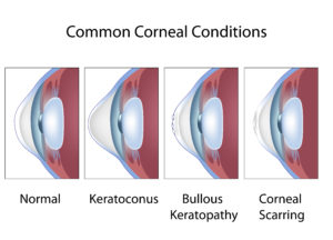Common Cornea Conditions