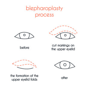 blepharoplasty