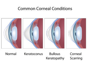 cornea-conditions