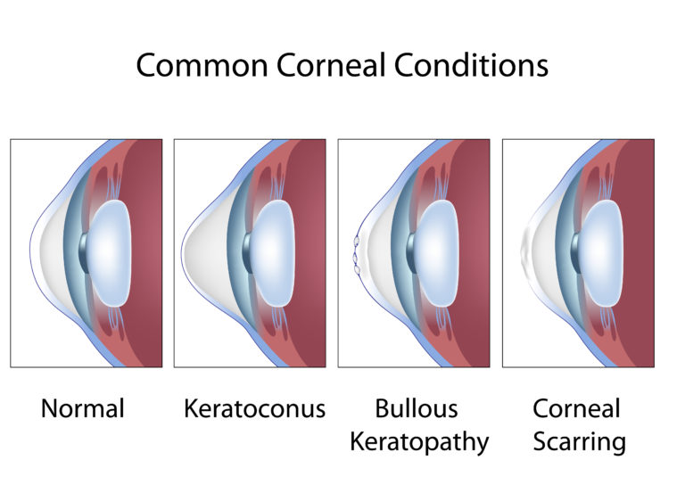 Corneal Disease Hendersonville Cornea Specialist Asheville