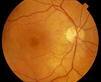 Macular Hole