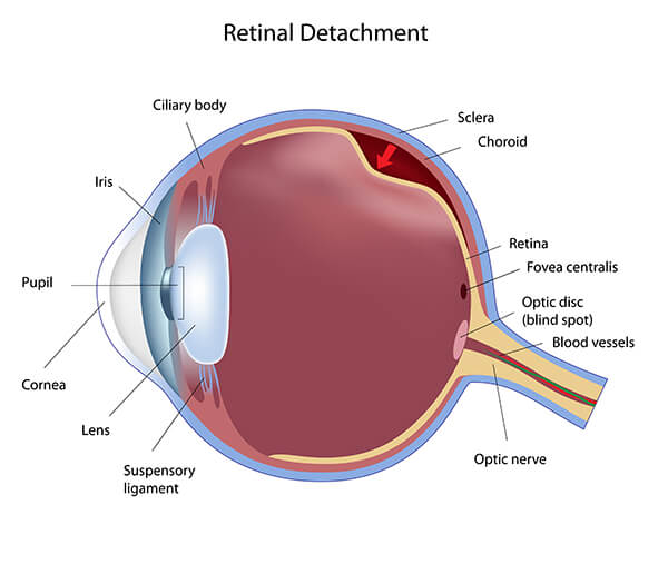 Retinal Detachment