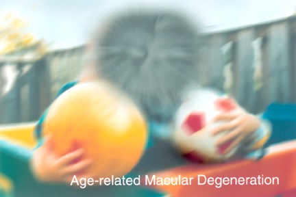 Age-Related Macular Degeneration (ARMD)