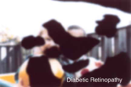 Diabetic Retinopathy